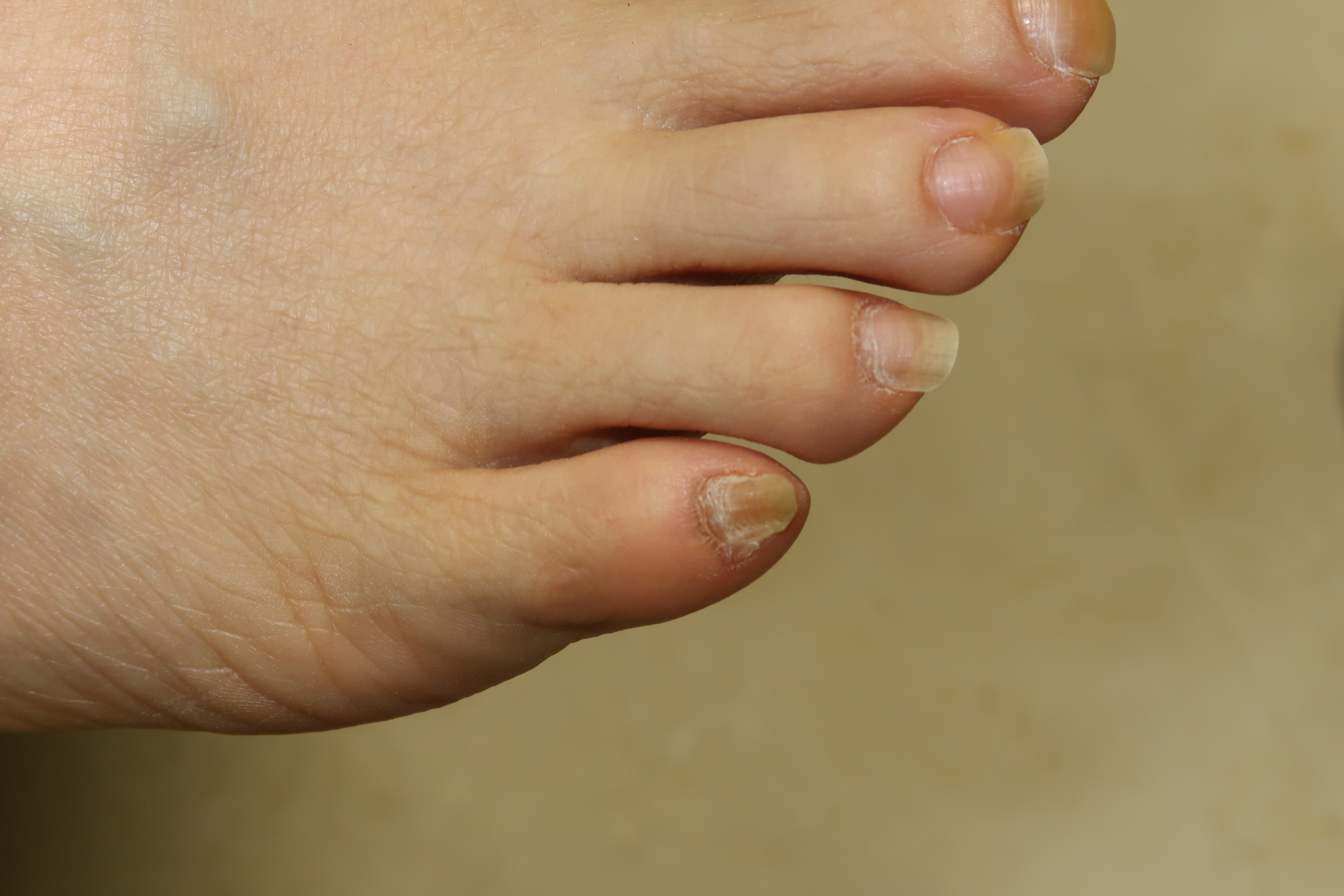 足 の 小指 足の小指が痛い原因と対策のまとめ