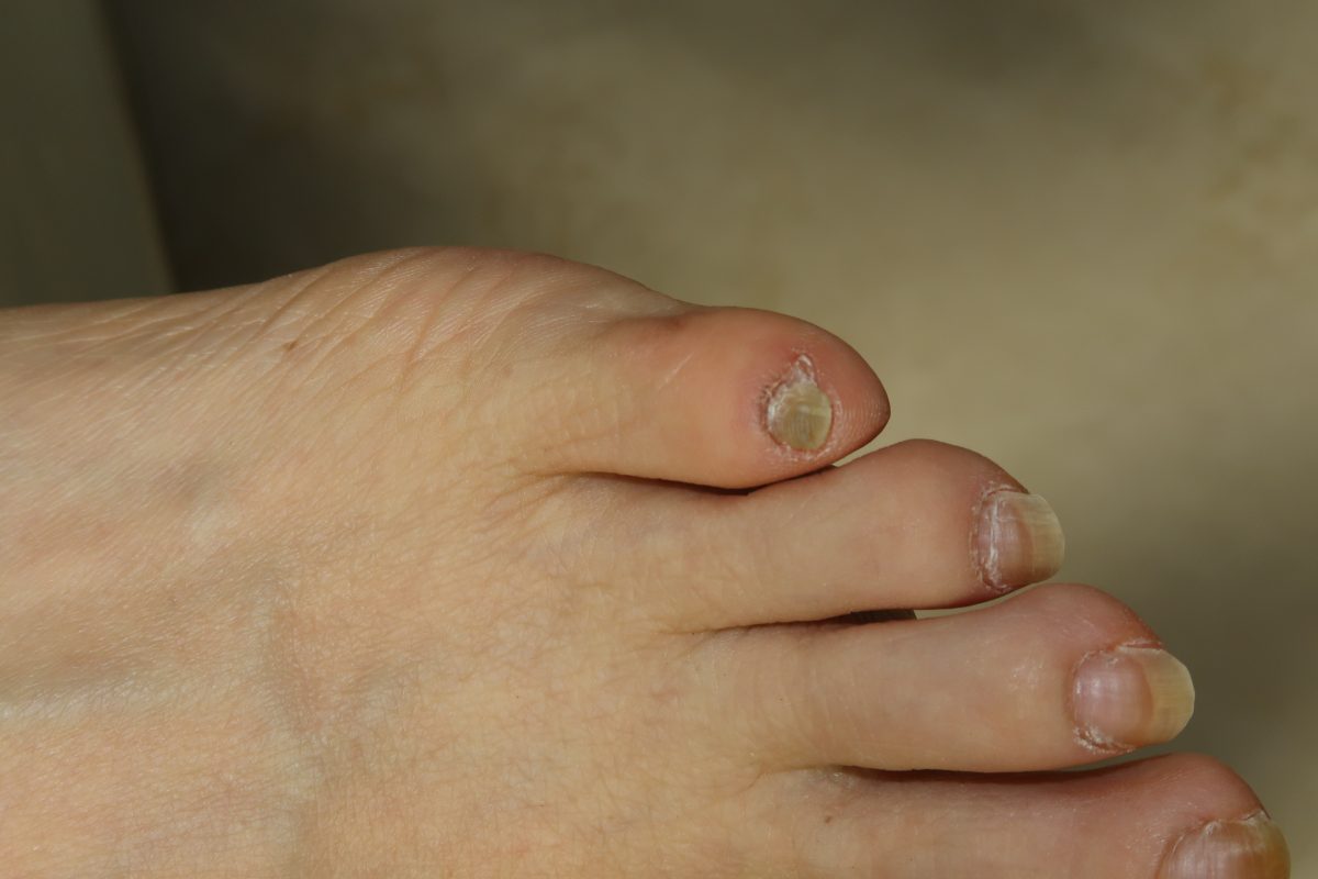 足 の 小指 の 爪 変形